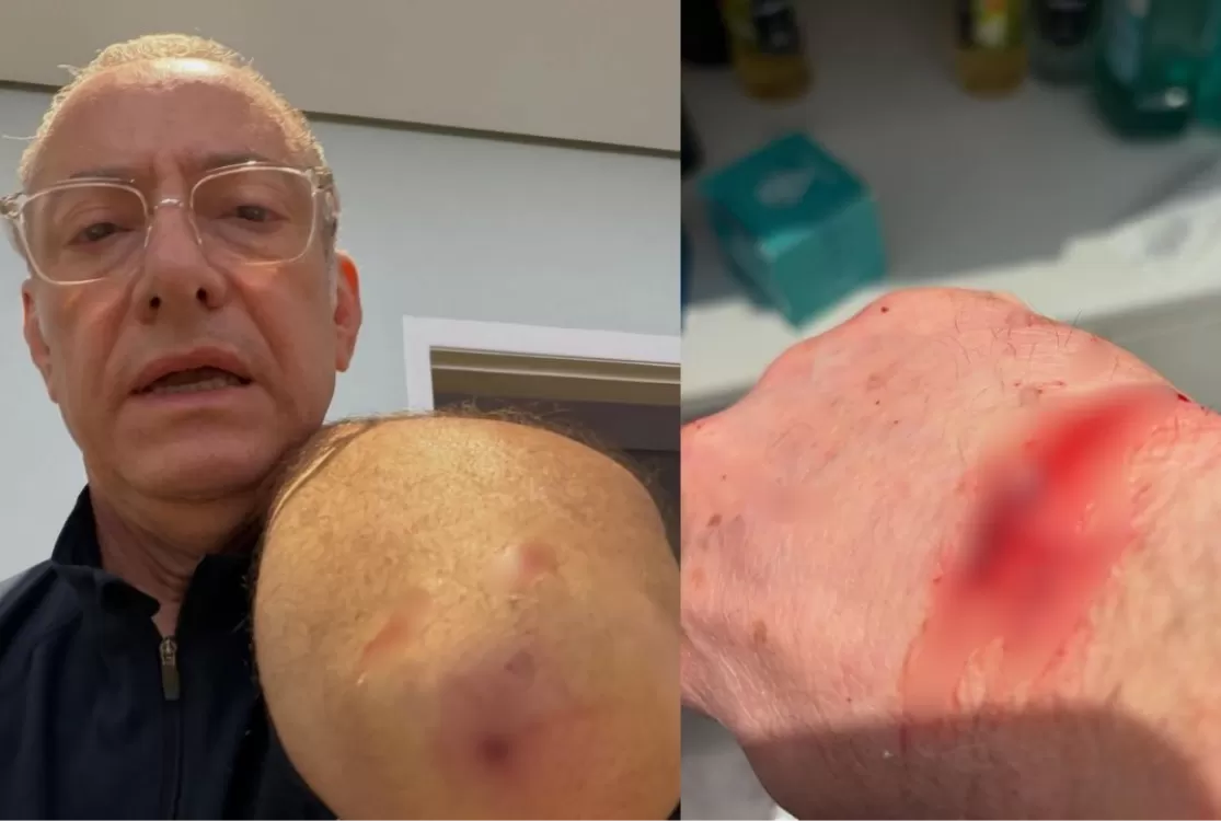 Jornalista José Roberto Burnier é atacado por pitbull sem guia: 'irresponsabilidade'