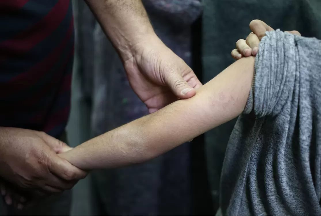 Aulas são suspensas em creche após suspeita de surto de sarna humana